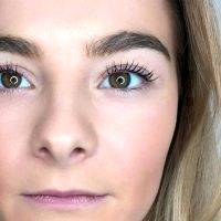 A Rhytidectomy Gives A More Youthful Facial Appearance