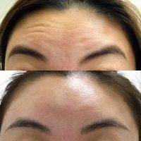 Botox Facelift Before After Pic