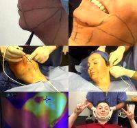 Lower Rhytidectomy Rejuvenates The Bottom Third Of The Face