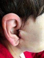 SMAS Facelift Stiches