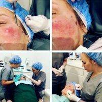 What Is A Thread Facelift Photo